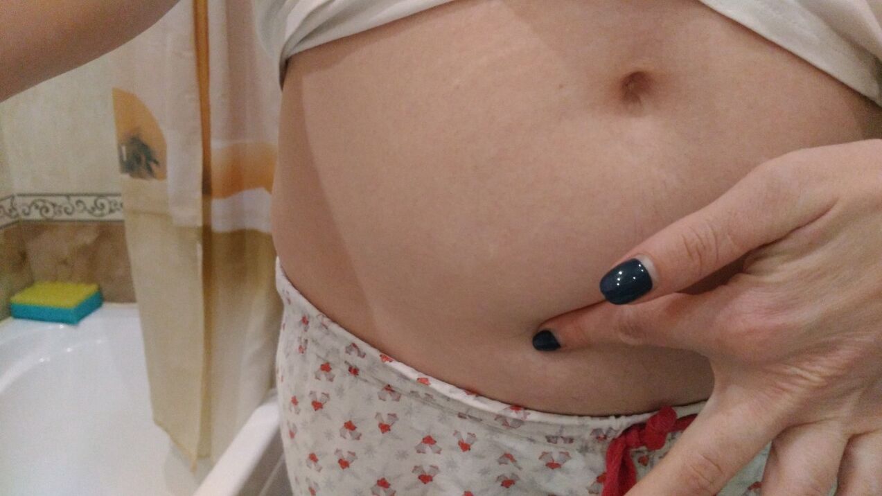 Helminto infekcijos požymiai iš asmeninės patirties